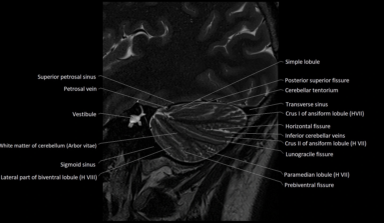 MRI Cerebellar anatomy sagittal High-resolution labelled image 10.webp
